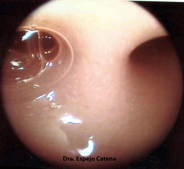 Imagen histeroscópica de una sinequia mucosa intraútero
